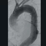 ci-aorticarch-ziehmvisionrfdhybridedition-cmosline.750x750