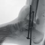 ci-biotalarandsubtalarjoints-ziehmvisionrfd3d-cmosline.640x640